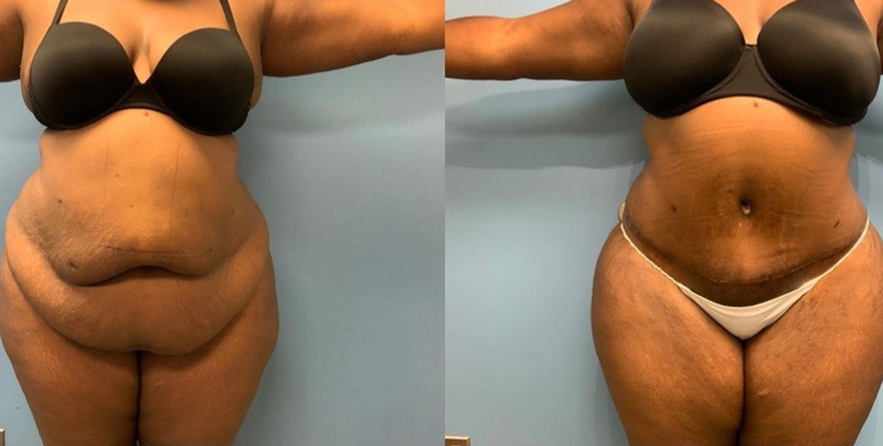 Before and after tummy tuck Zinsser Plastic Surgery, Richmond, VA