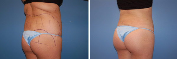 Butt lift before and after Zinsser Plastic Surgery, Richmond VA
