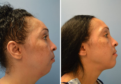 Neck lift before and after Zinsser Plastic Surgery, Richmond VA