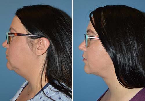 Neck lift before and after Zinsser Plastic Surgery, Richmond VA