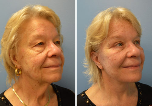 Facelift before and after Zinsser Plastic Surgery, Richmond VA