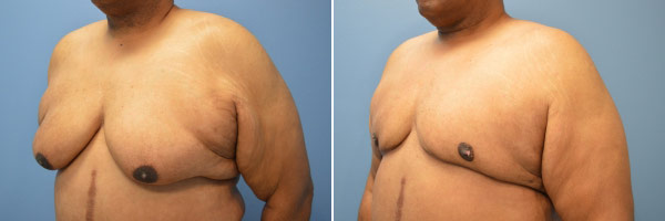 Gynecomastia before and after Zinsser Plastic Surgery, Richmond VA