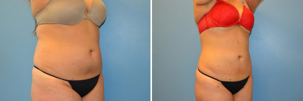 Liposuction before and after Zinsser Plastic Surgery, Richmond VA