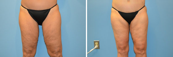 Thigh lift before and after Zinsser Plastic Surgery, Richmond VA