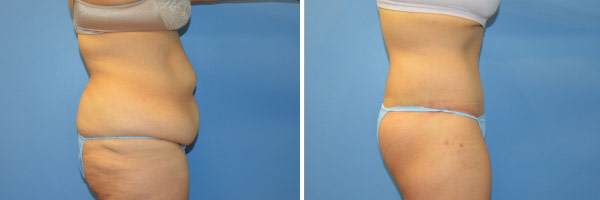 Tummy tuck before and after Zinsser Plastic Surgery, Richmond VA