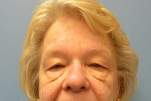 before blepharoplasty front view female patient case 3798