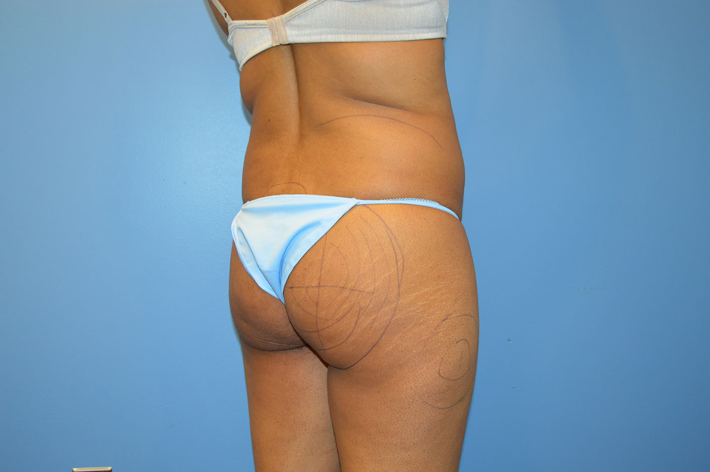 before brazilian butt lift bbl diagonal view Richmond, VA Zinsser Plastic Surgery