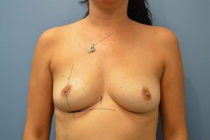 before breast augmentation front view Richmond, VA Zinsser Plastic Surgery
