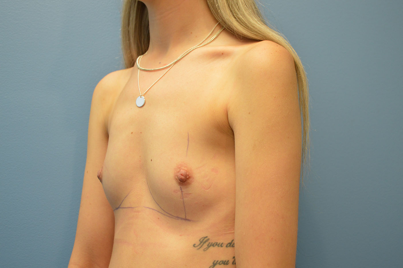 before breast augmentation left angle view Richmond, VA Zinsser Plastic Surgery