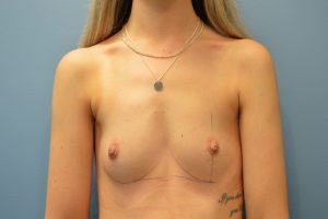 before breast augmentation front view Richmond, VA Zinsser Plastic Surgery