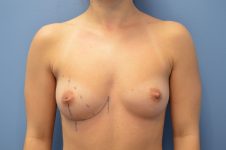 before breast augmentation front view Richmond, VA Zinsser Plastic Surgery