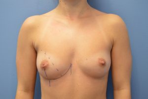 before breast augmentation front view Richmond, VA Zinsser Plastic Surgery