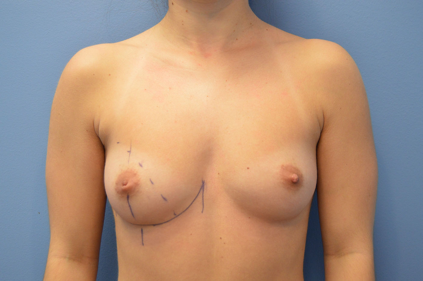 before breast augmentation front view Richmond, VA Zinsser Plastic Surgery