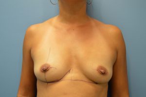 before breast augmentation front view Richmond, VA Zinsser Plastic Surgery