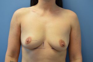 before breast augmentation front view Richmond, VA Zinsser Plastic Surgery