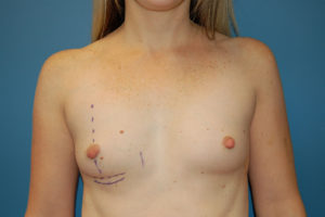 before breast augmentation front view Richmond, VA Zinsser Plastic Surgery