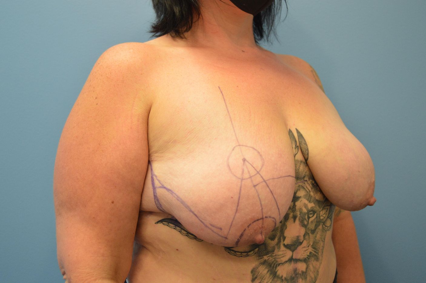 Before breast lift right angle view female patient case 4001