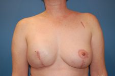 after breast reconstruction front view Richmond, VA Zinsser Plastic Surgery