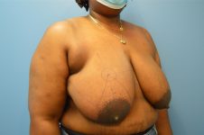 before Breast Reduction right angle view female patient case 3182
