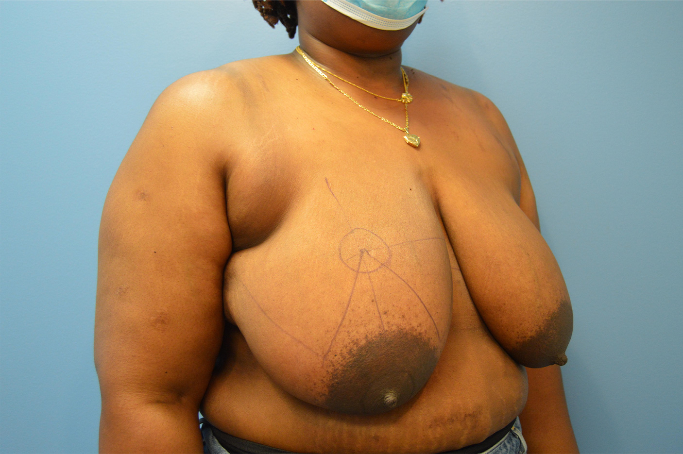 before Breast Reduction right angle view female patient case 3182