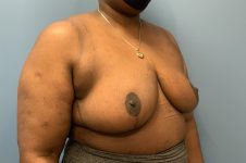 after Breast Reduction right angle view female patient case 3182