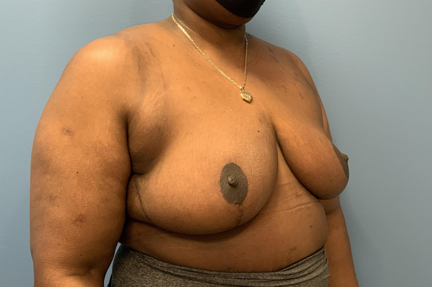 after Breast Reduction right angle view female patient case 3182