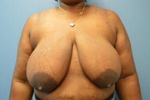 before Breast Reduction front view female patient case 3182