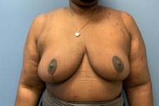 after Breast Reduction front view female patient case 3182