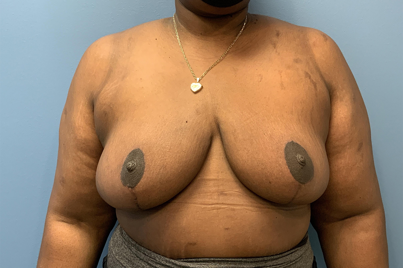 after Breast Reduction front view female patient case 3182