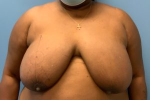 Before breast reduction front view female patient case 3996