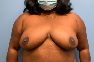 after breast reduction front view female patient case 3996