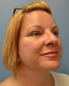 after brow lift diagonal view Richmond, VA Zinsser Plastic Surgery