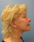 after Facelift right side view female patient case 3197