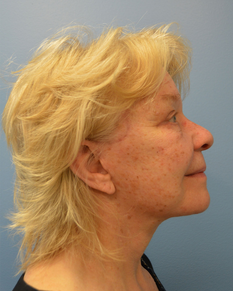after Facelift right side view female patient case 3197