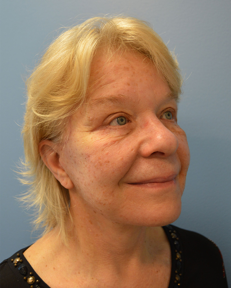 after Facelift right angle view female patient case 3197