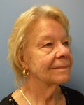 before Facelift right angle view female patient case 3197