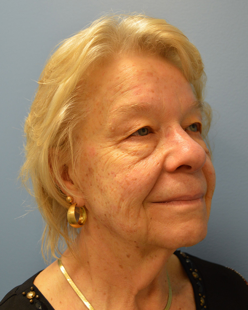 before Facelift right angle view female patient case 3197