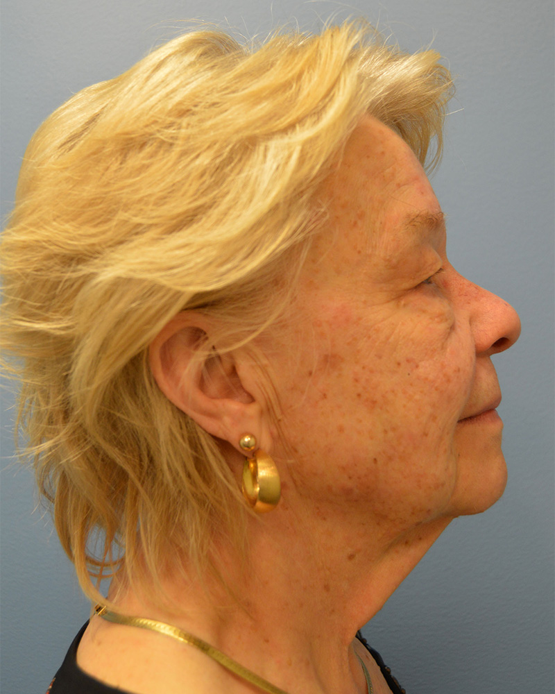 before Facelift right side view female patient case 3197