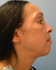 after Neck Lift right side view female patient case 3202