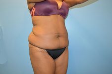 before tummy tuck right angle view Richmond, VA Zinsser Plastic Surgery