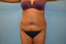 before tummy tuck front view Richmond, VA Zinsser Plastic Surgery