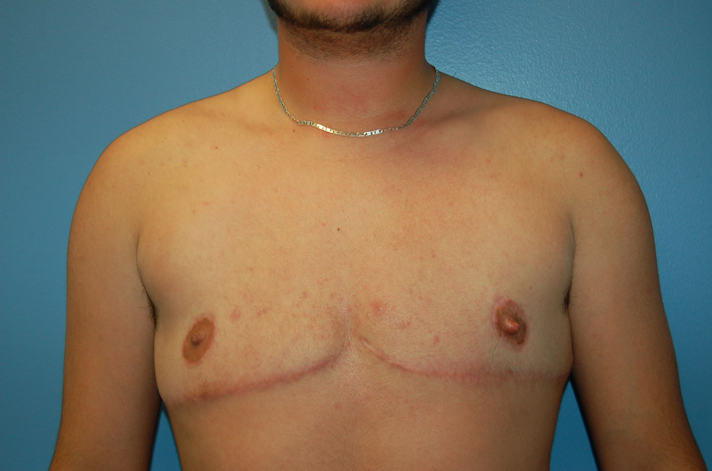 after transgender top surgery front view Richmond, VA Zinsser Plastic Surgery