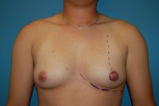 before transgender top surgery front view Richmond, VA Zinsser Plastic Surgery