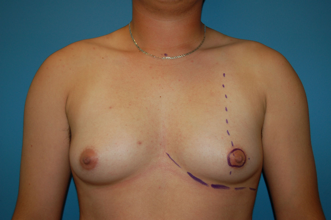 before transgender top surgery front view Richmond, VA Zinsser Plastic Surgery