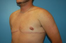 after transgender top surgery left angle view Richmond, VA Zinsser Plastic Surgery