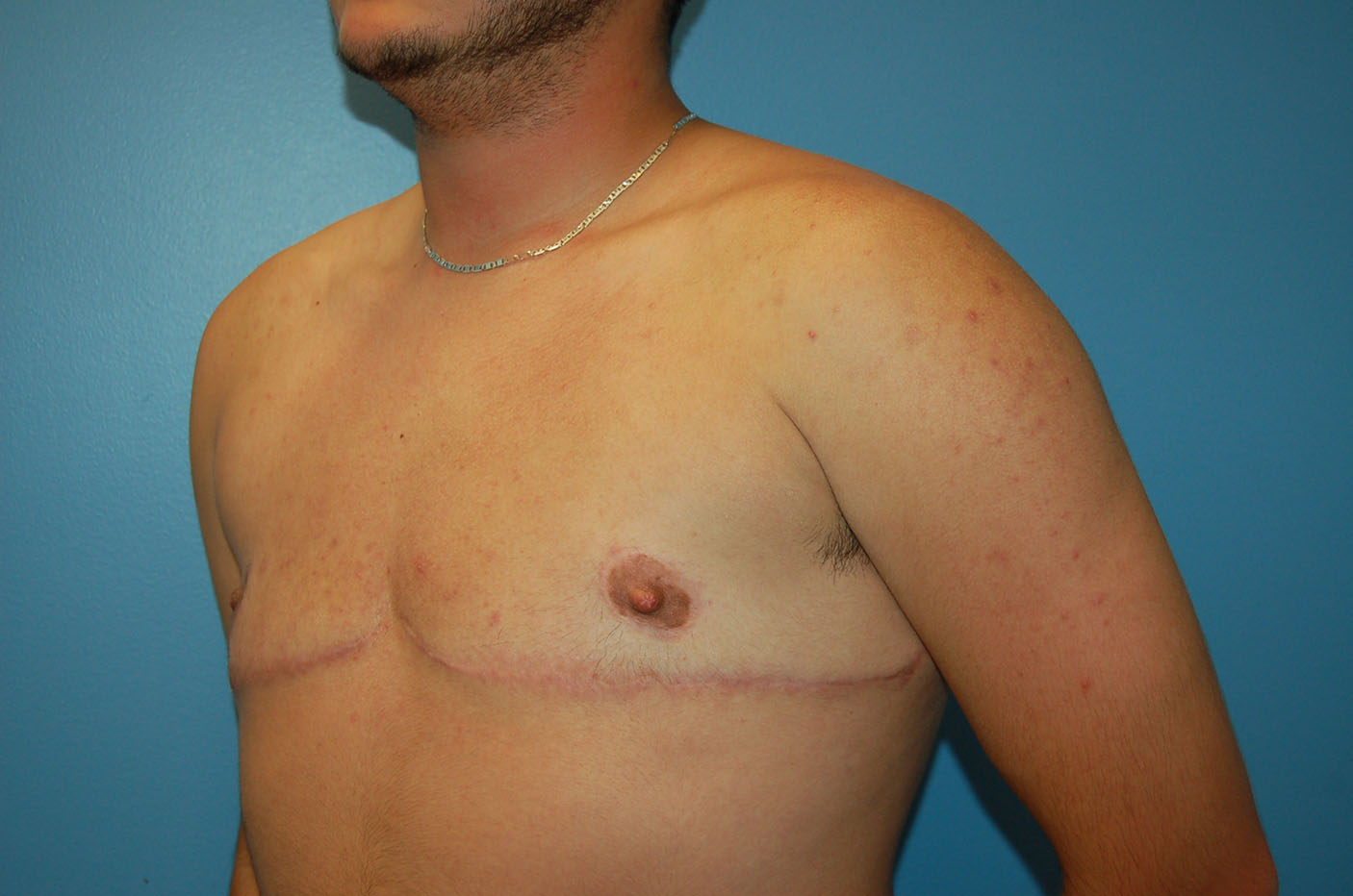 after transgender top surgery left angle view Richmond, VA Zinsser Plastic Surgery