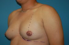 before transgender top surgery left angle view Richmond, VA Zinsser Plastic Surgery