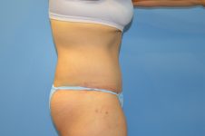 after tummy tuck right view Richmond, VA Zinsser Plastic Surgery