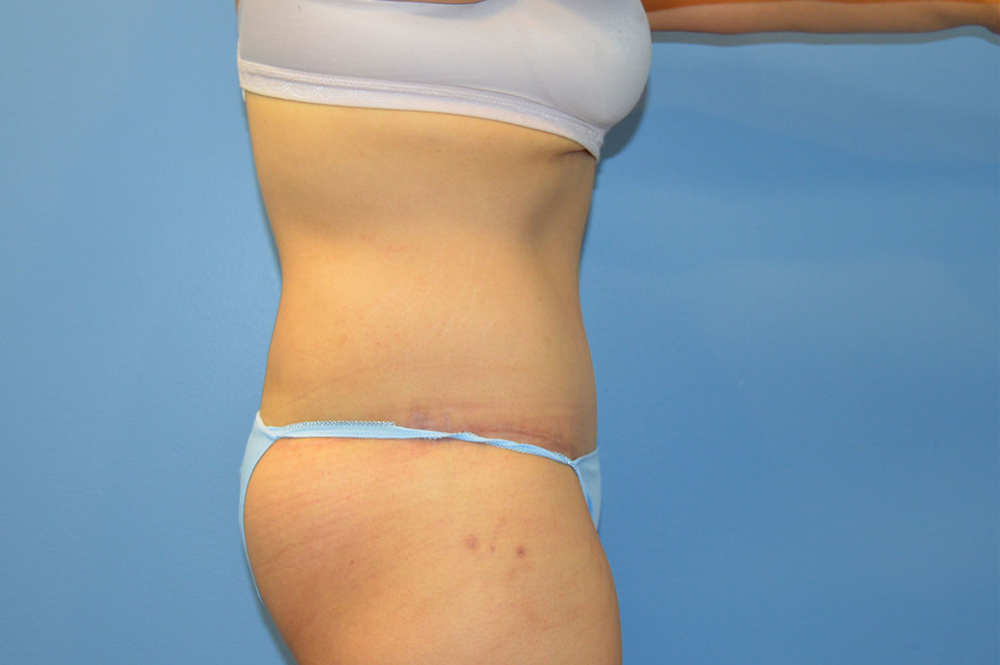 after tummy tuck right view Richmond, VA Zinsser Plastic Surgery