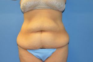 before tummy tuck front view Richmond, VA Zinsser Plastic Surgery